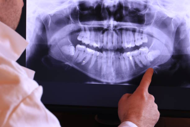 Best Emergency Wisdom Teeth Removal in Belmont, CA