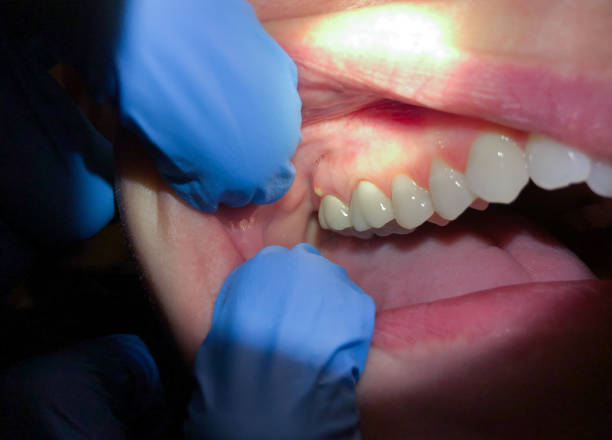 Best Emergency Tooth Extraction in Belmont, CA