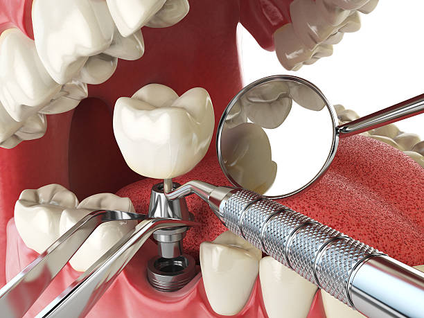 Best Same-Day Emergency Dental Services in Belmont, CA